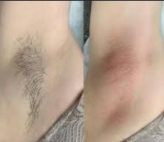 Antes e depois — Axila