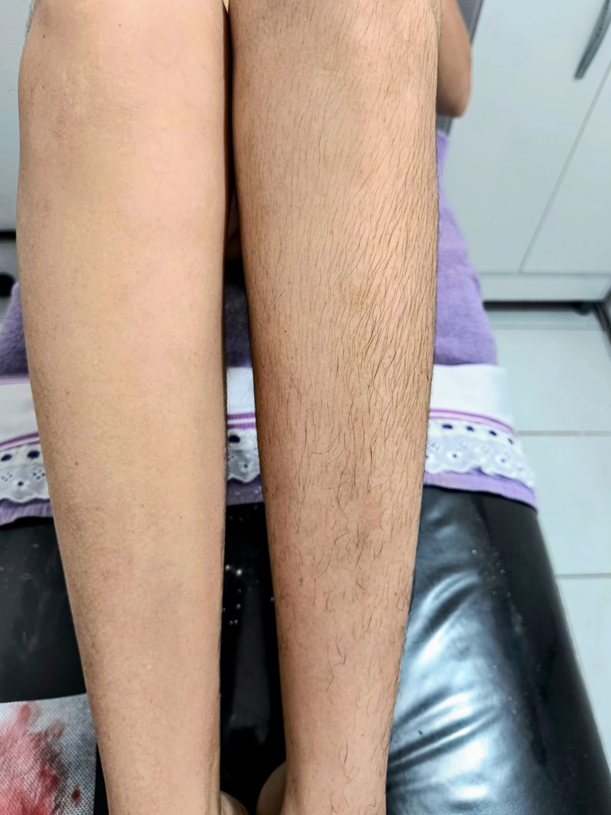 Antes Perna Completa